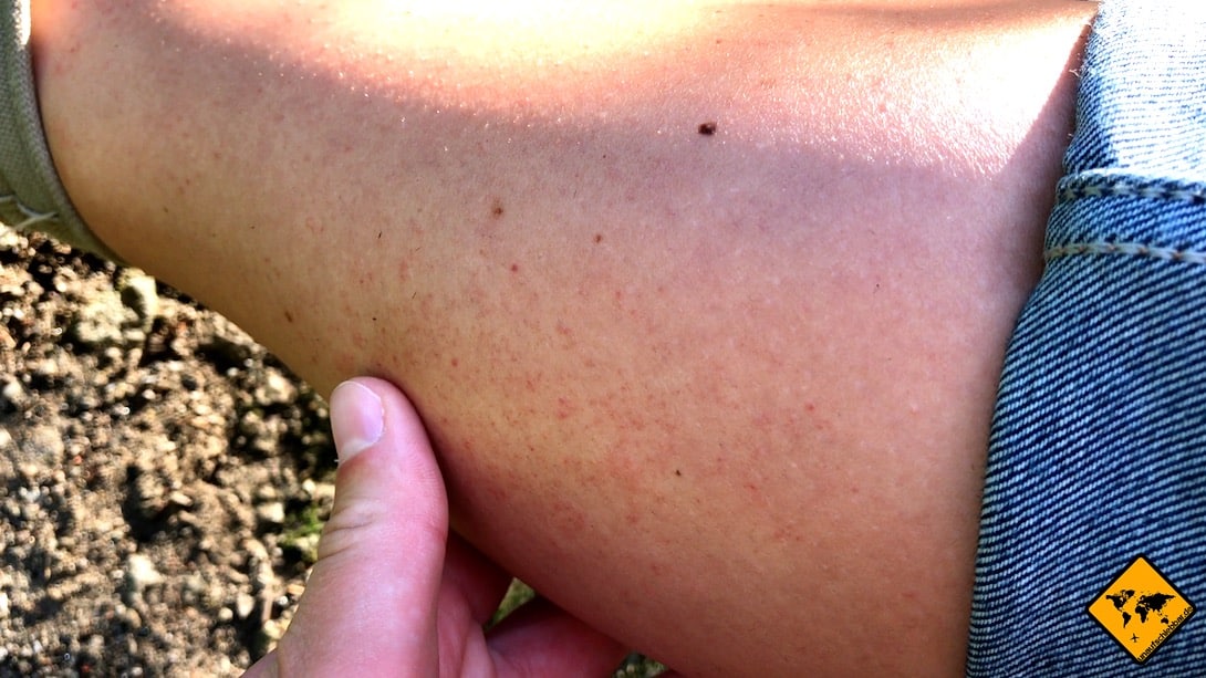 Das NOBITE Hautspray hatte bei Jenny im Mückenspray Test eine kleine Hautrötung an der Wade hervorgerufen